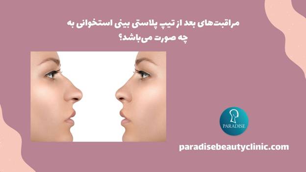 مراقبت‌های بعد از تیپ پلاستی بینی استخوانی به چه صورت می‌باشد؟