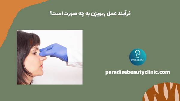 فرآیند عمل ریویژن به چه صورت است؟