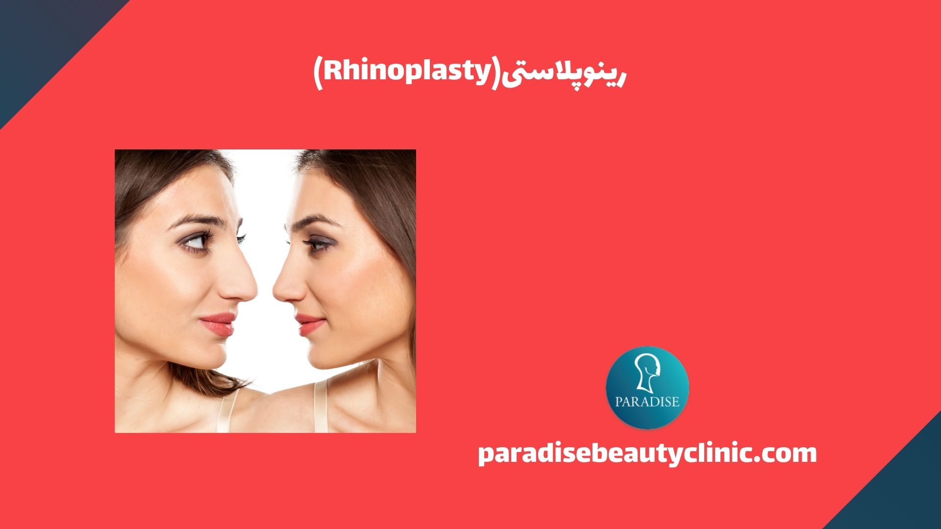 رینوپلاستی(Rhinoplasty)