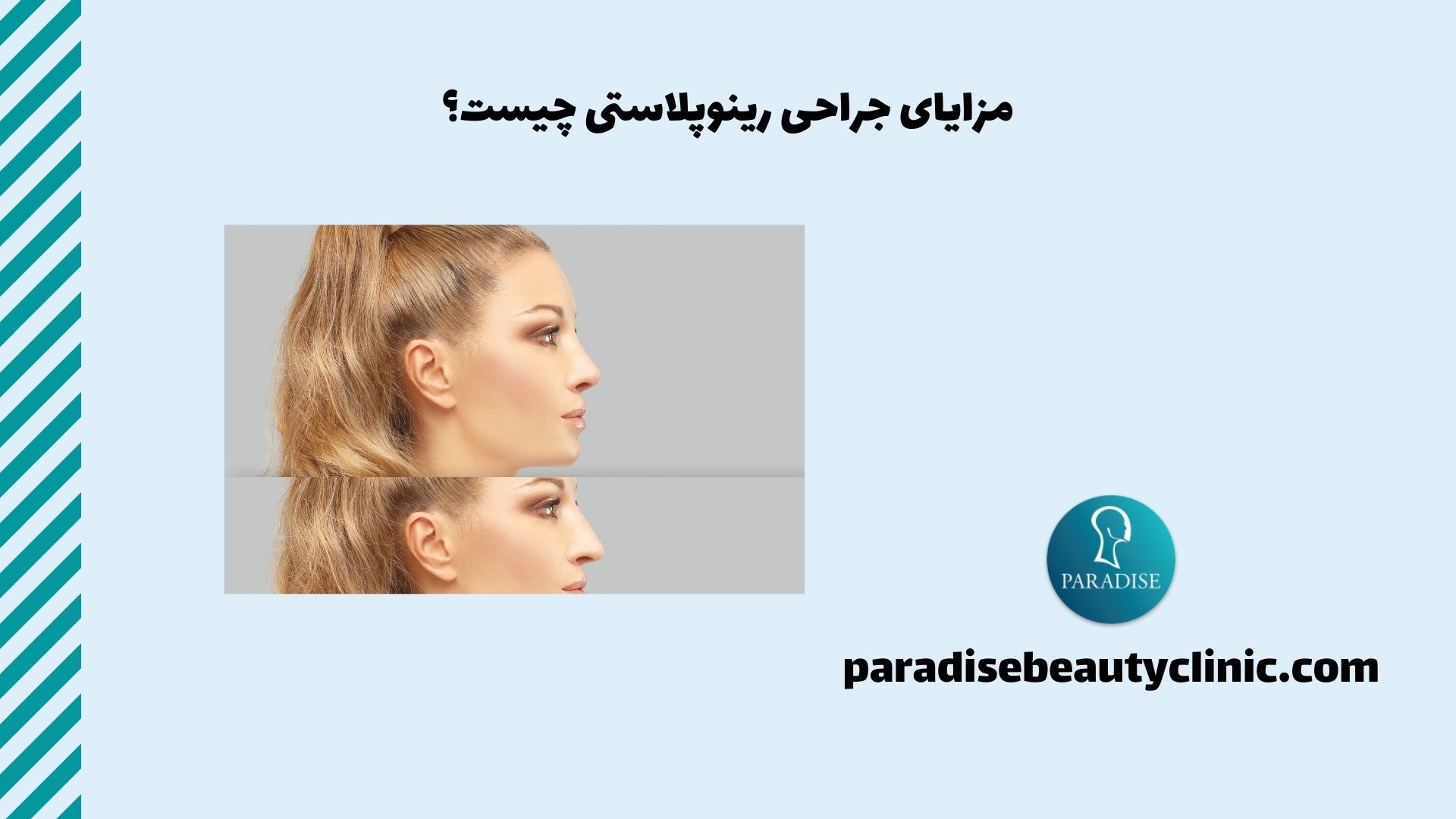 مزایای جراحی رینوپلاستی چیست؟