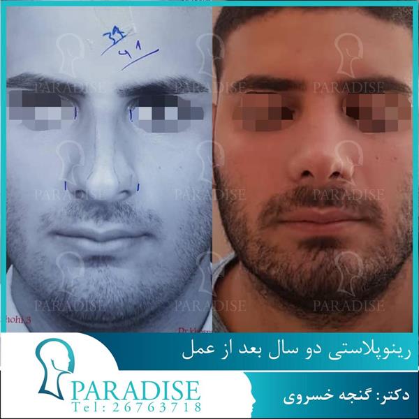 عکس عمل زیبایی بینی رینو پلاستی دکتر هومن گنجه خسروی